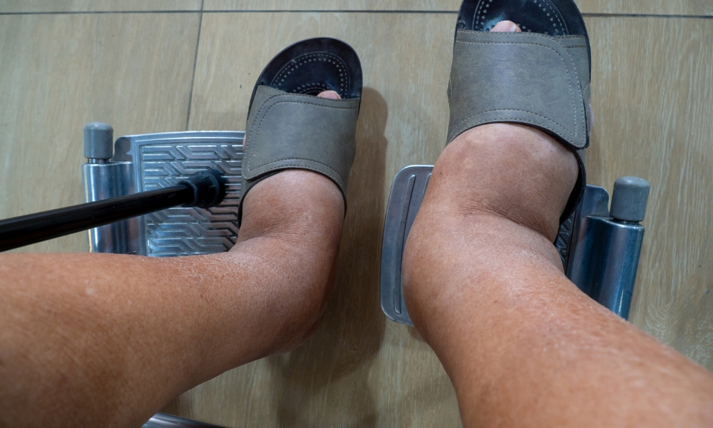 Healthcare provider evaluating ankle and foot swelling during a medical examination