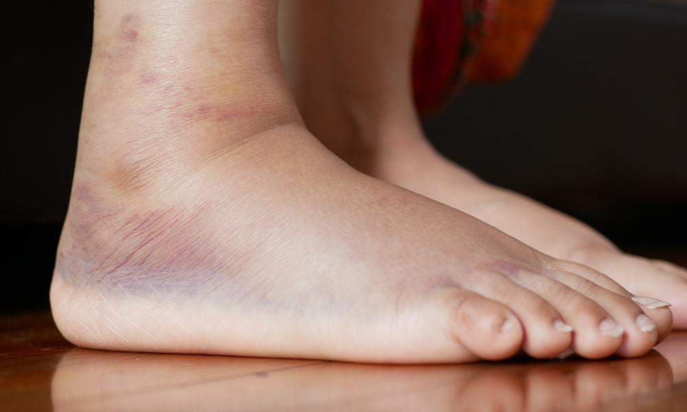 Illustration showing fluid accumulation in feet and ankles throughout the day