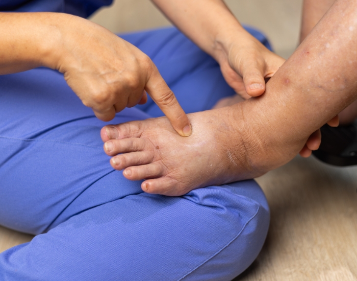 Why Do My Feet Swell at the End of the Day?